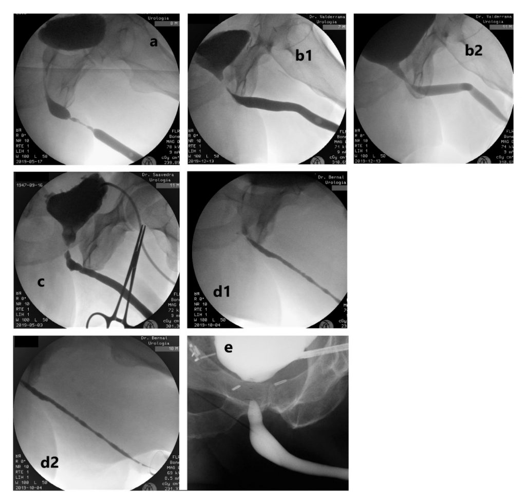 Figura 7. Diferentes imágenes de uretrocistografía. a) Estrechez uretra bulbar media-distal. b1) Estrechez unión bulbomembranosa post-prostatectomía radical + radioterapia (fase retrógrada que no es capaz de definir ubicación real por sí sola). b2) Mismo caso anterior, donde se observa apertura adecuada de la anastomosis uretrovesical y de la uretra membranosa, definiendo la estrechez en la unión bulbomembranosa (fase miccional). c) Estudio anterógrado (por cistostomía) y retrógrado en simultáneo, evidenciando estrechez crítica de unión bulbomembranosa post adenomectomía transvesical; vejiga de lucha y cuello vesical abierto espontáneamente. d1 y d2) Panestrechez de uretra anterior, con segmento crítico en uretra bulbar proximal. e) Estudio con cistoscopía anterógrada flexible y UCG retrógrada en simultáneo, de una estenosis obliterada de la anastomosis uretrovesical post-prostatectomía radical.