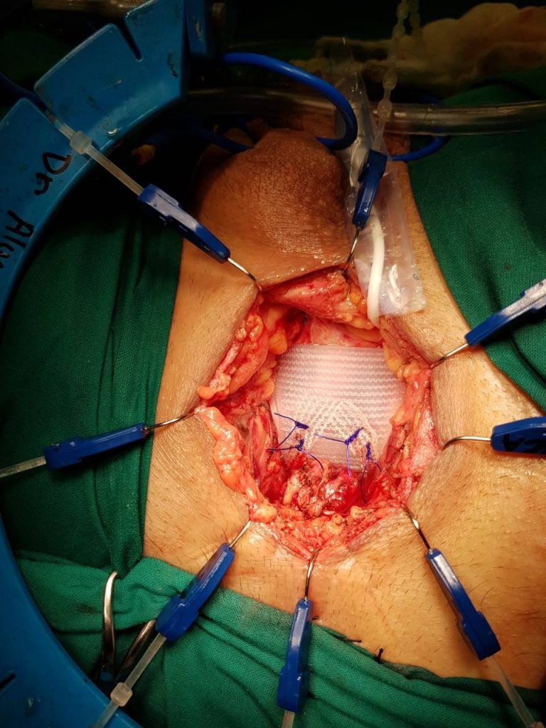 Fig. 18. Posición final de sling ajustable ATOMS en cara ventral de uretra bulbar media.