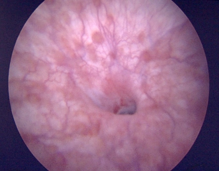 Fig. 19. Hallazgo del ostium vesical de una FVV en la cistoscopía
