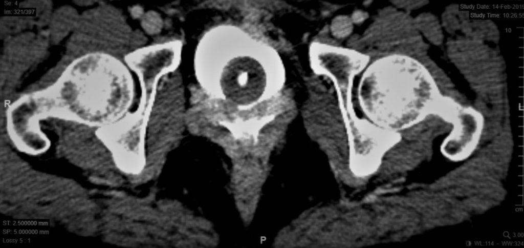 Fig. 20. Aspecto de una fístula vesicovaginal al TAC con contraste de llenado por la sonda uretral (cistoTAC). Se observa claramente cómo contrasta la vagina