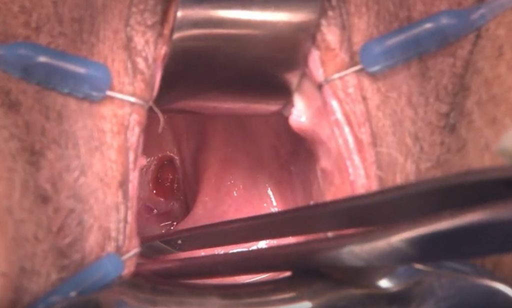 Fig. 21. Visualización del ostium vaginal de una FVV durante la cirugía.