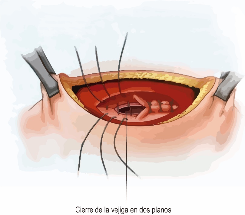 Fig. 23. Cierre de la vejiga en 2 planos.