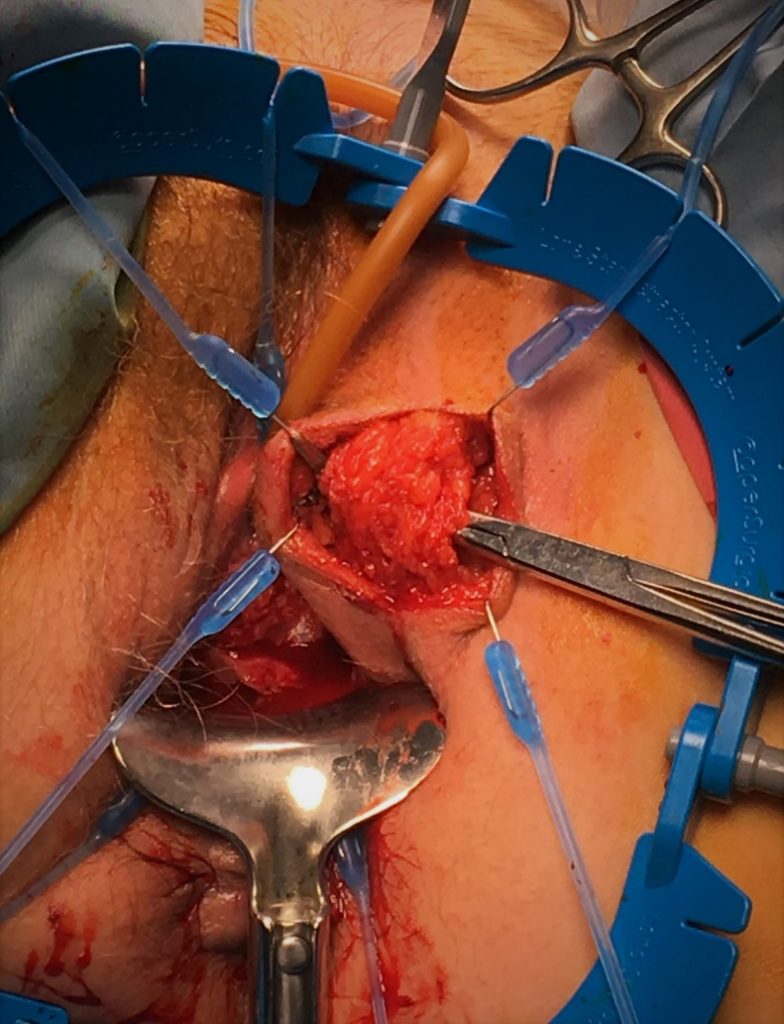 Fig. 24. Preparación de Flap de Martius desde labio mayor izquierdo.