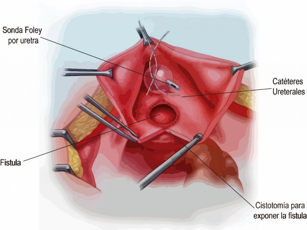 Fig. 25. Exposición transvesical de la vejiga y del ostium vesical de una FVV. durante una cirugía por vía abdominal.