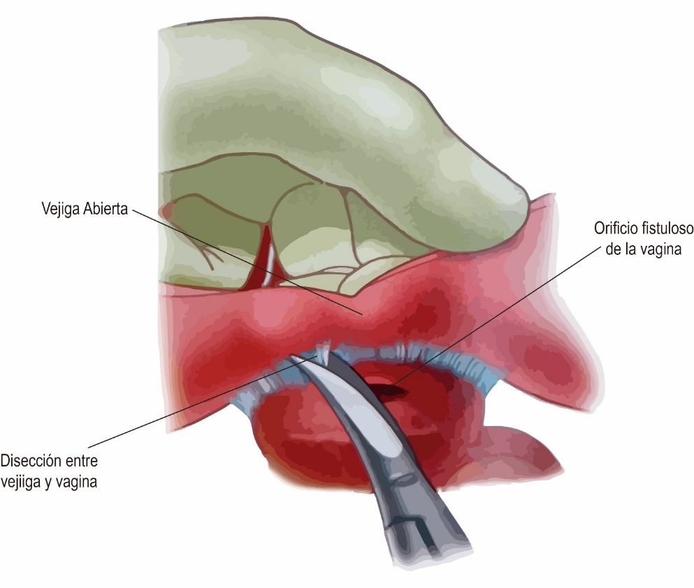Fig. 26. Exposición y disección del trayecto fistuloso por la cara posterior de la vejiga durante el abordaje abdominal.