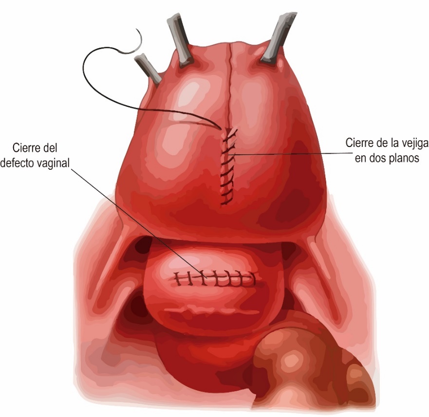 Fig. 27. Cierre de vejiga y vagina durante un abordaje abdominal. Posteriormente puede interponerse un colgajo de peritoneo o de omento.
