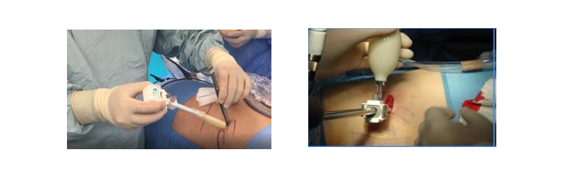 Fig. 14. Balón disector del retroperitoneo. (Spacemaker™ Structural Balloon Trocar, Covidien)
