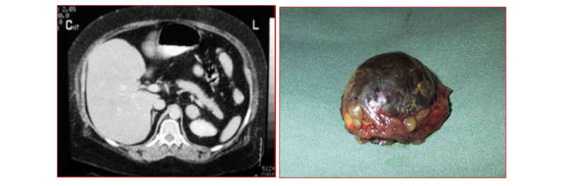 Fig. 16. Incidentaloma de 3 cm, reemplaza completamente la glándula adrenal.