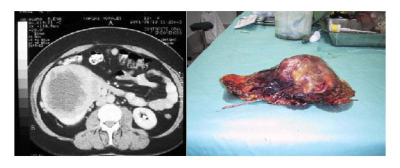 Fig. 22. Tumor renal T2 localizado y pieza quirúrgica obtenida por laparoscopía