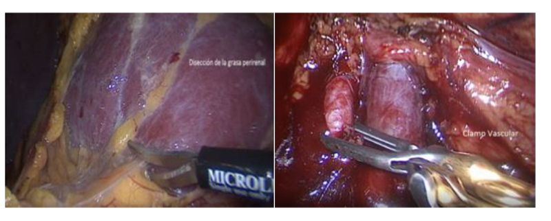 Fig. 25. Disección renal, hasta identificar Hilio renal para su clampeo.
