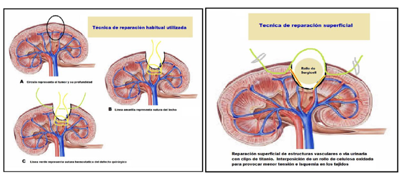 Fig. 28. Esquema de técnicas de reparación del defecto quirúrgico en NPL