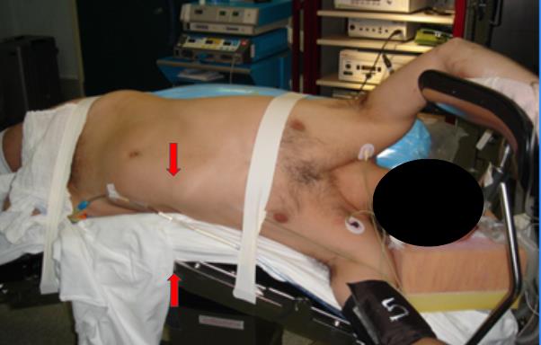 Fig. 3 Línea de quiebre de la mesa en reborde costal