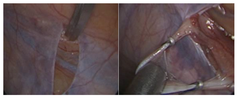 Fig. 33. Técnica de varicocelectomia laparoscópica