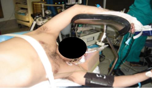 Fig. 6. Posición de “clavado o piquero”