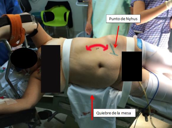 Fig. 7. Demarcación Punto de Nyhus y se pone en evidencia mayor separación costo ilíaca.