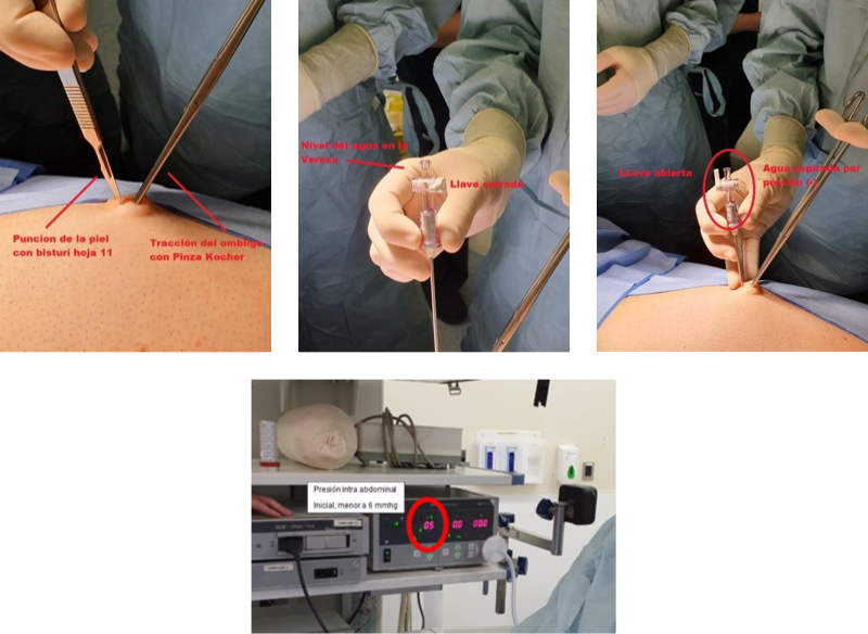 Fig. 8 Técnica de realización del pneumoperitoneo