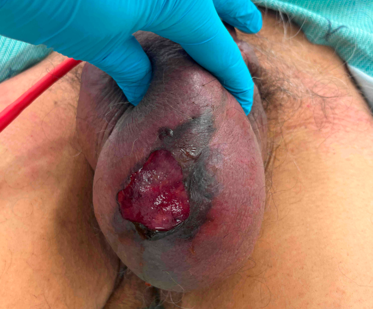 A person with a wound on the butt Description automatically generated with medium confidence