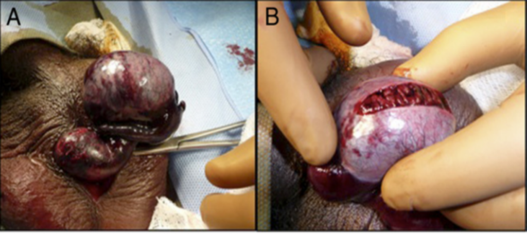 Fig. 12. Imagen macroscópica de torsion testicular