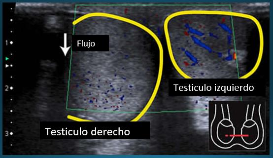 Fig 13. Flujo arterial disminuido en Torsion Testicular
