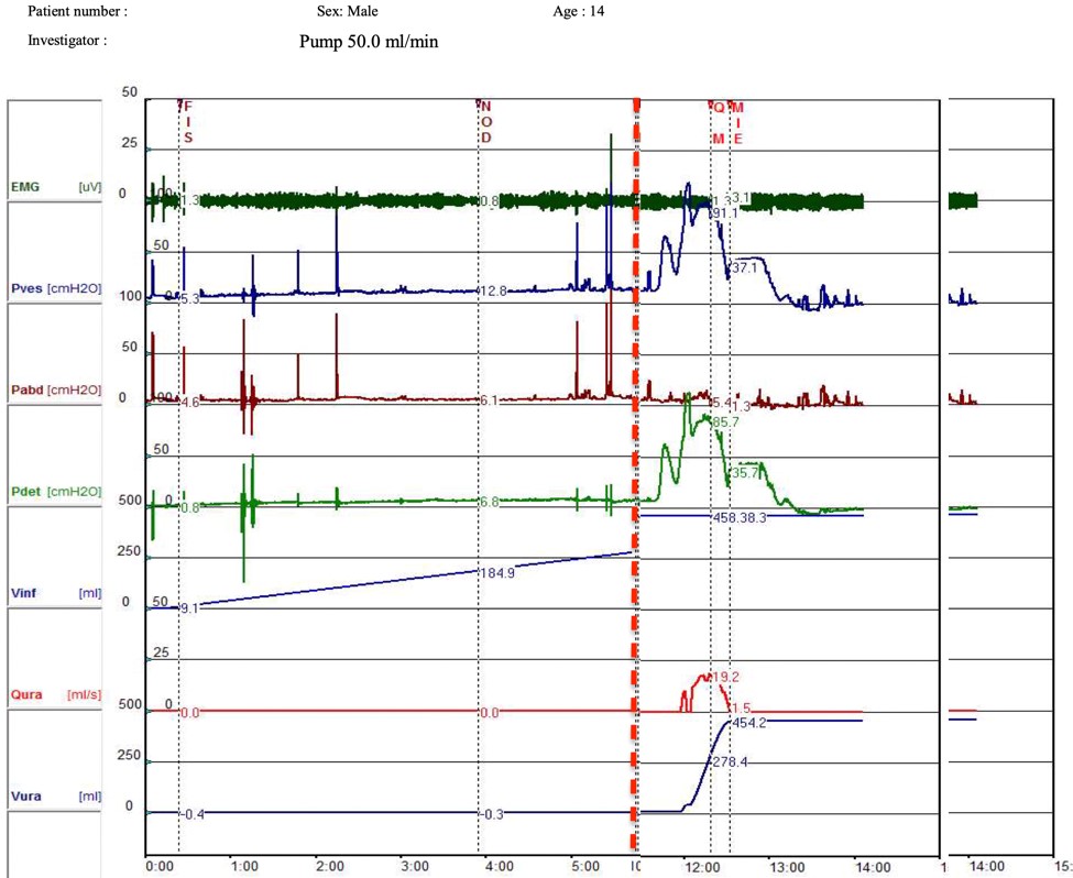 Fig. 4. Trazado urodinámico (recortado). Se observa que una vez terminado el llene, a 460 ml, se inició el vaciado observando flujo máximo de 19 ml/s y presión de detrusor a flujo máximo de 86 cm de agua, solo dejando 5 ml como residuo post miccional.
