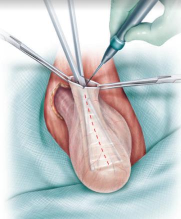 Fig. 6. Apertura de Túnica vaginal.