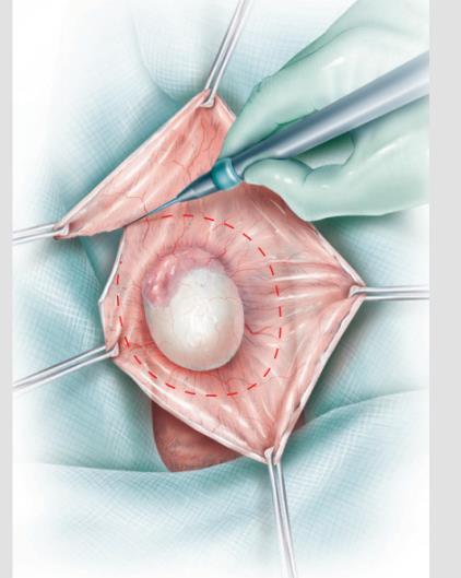 Fig. 7. Resección de tejido redundante.