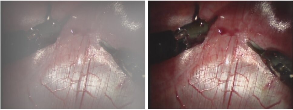 Surgical smoke removal via residual Swin transformer network ...